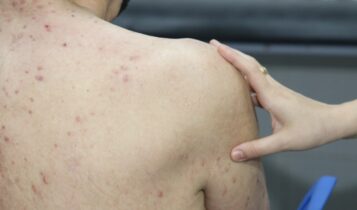 Dermatologista alerta sobre o diagnóstico precoce da hanseníase